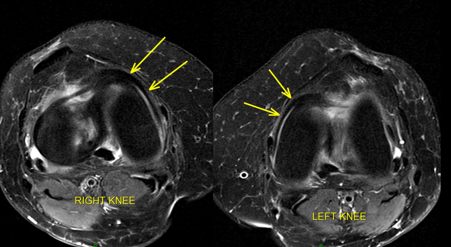 Figure 2 for case Fascicular Capsulofemoral Band